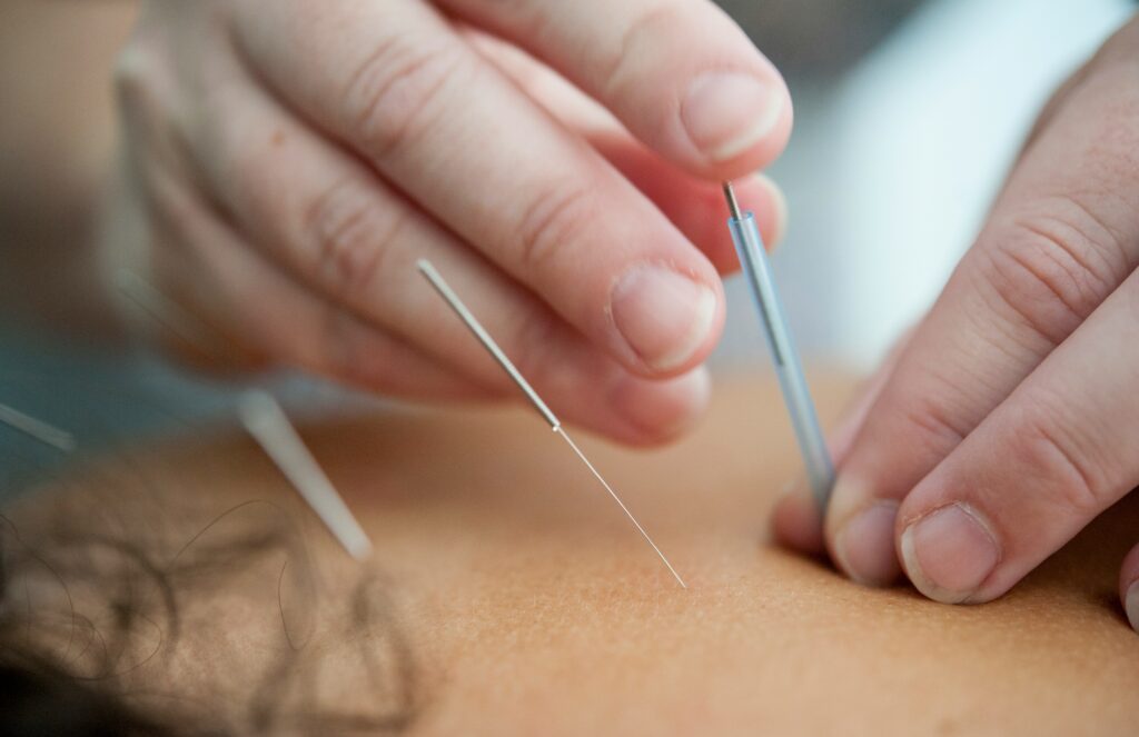 Unleash Your Potential: Dry Needling for Bellevue Athletes