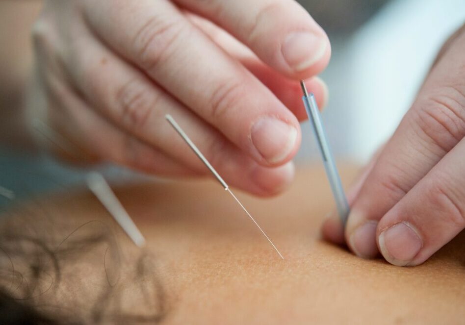 Unleash Your Potential: Dry Needling for Bellevue Athletes